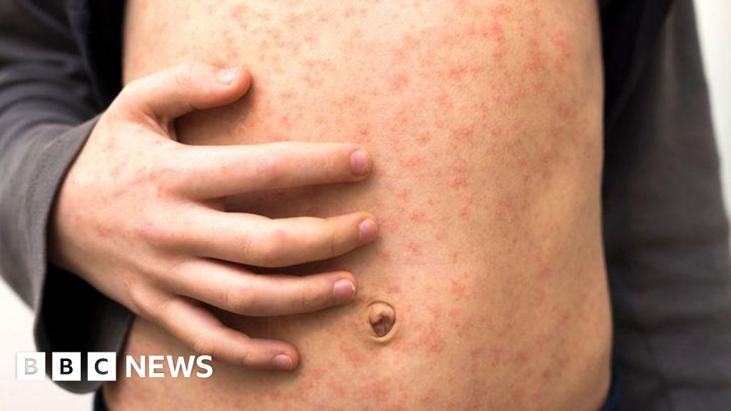 Measles Outbreak North London: Key Symptoms and Prevention Tips